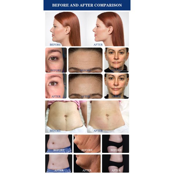 Crioterapia Cavitation RF Vacuum Slimming Machine Wrinkle Remover