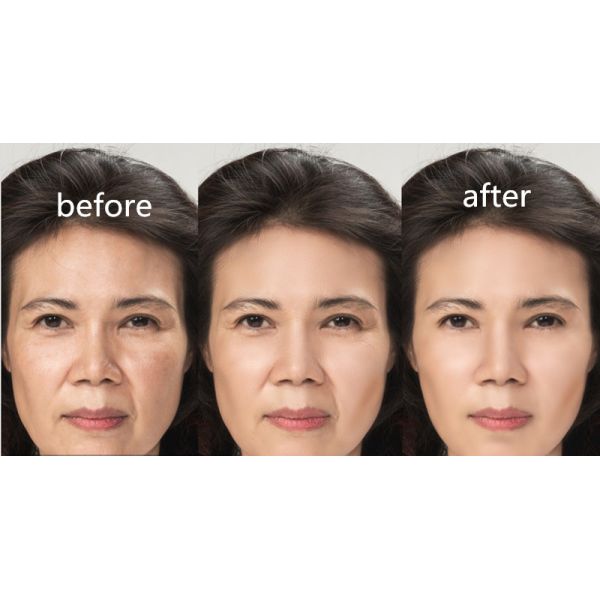 HA Mesotherapy Solution Face Lift Wrinkle Remove