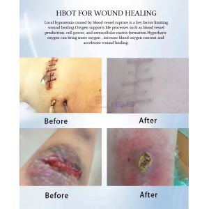 Medical Spa Lying Hyperbaric Chamber Oxygen Home Camara Hiperbaricas Improve