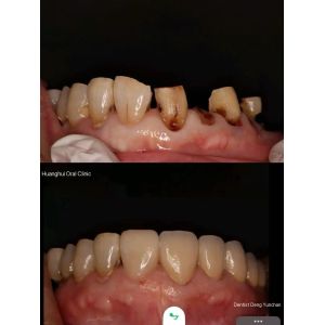 Zirconia dentures that imitate natural teeth