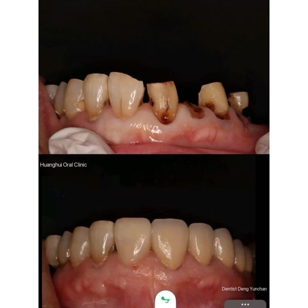 Buy Zirconia dentures that imitate natural teeth at wholesale prices