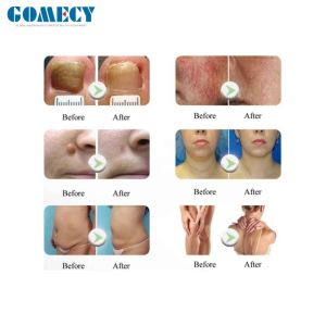 Non Invasive 980nm Diode Laser Nail Fungus Laser Machine