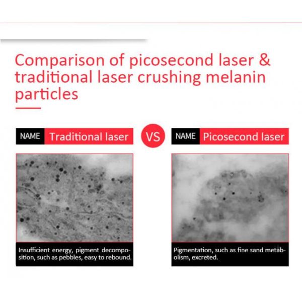 900ps Powerful Picosecond Laser For Tattoo Removal High Homogeneous Spot Mode 1