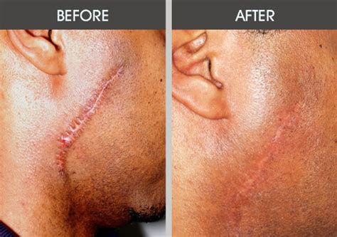 Salon CO2 Fractional Laser Machine Stretch Mark Removal With RF Metal Tube