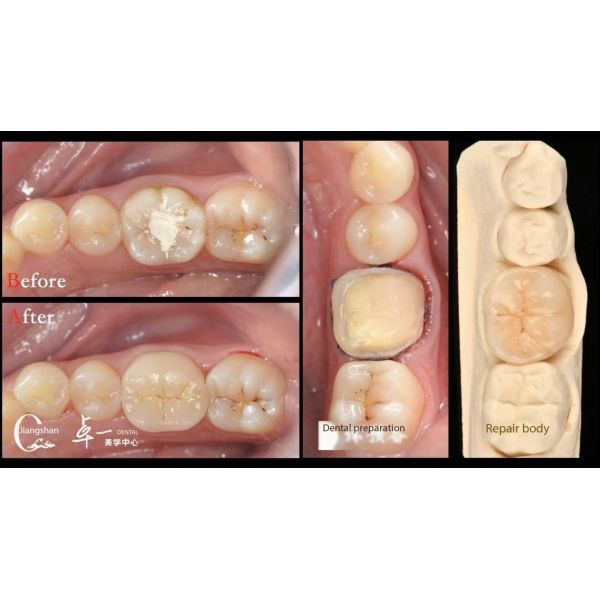Biocompatibility And High Compatibility With Natural Teeth Restoration Dental