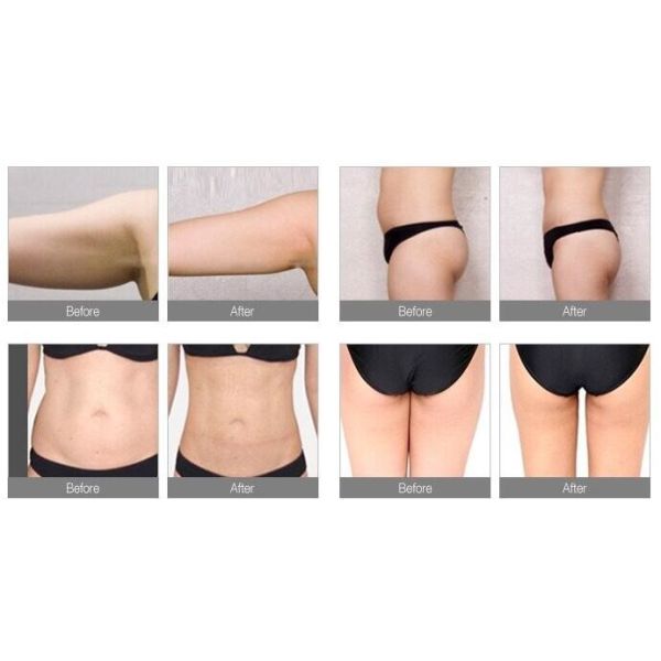 25m3/H Cryolipolysis Rf Vacuum Cavitation Machine