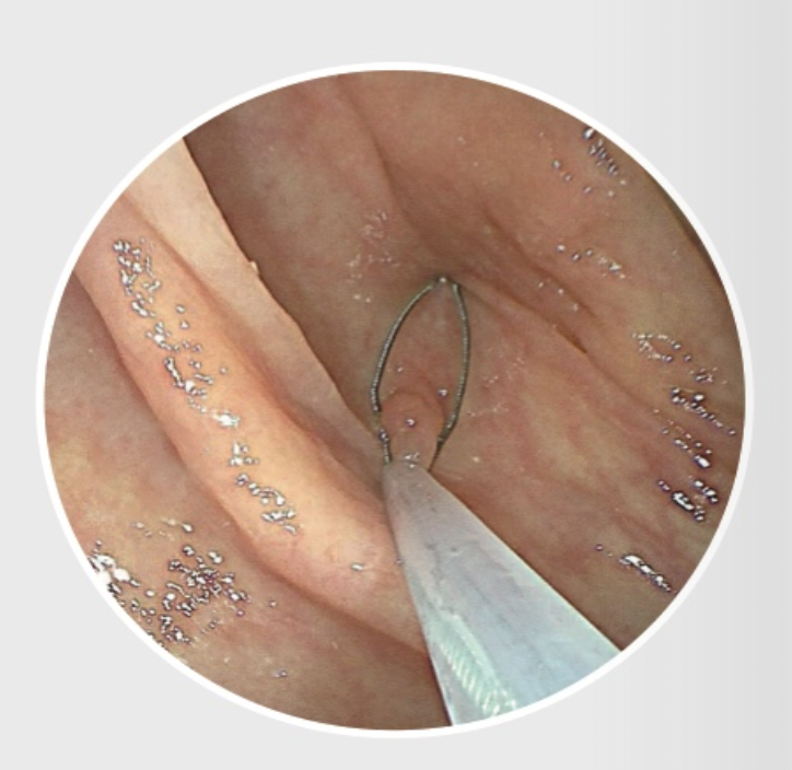 Disposable Cold Polyp Resection