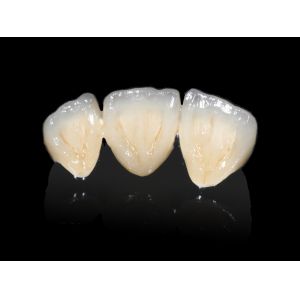 Buy cheap Implant Dental PFM Bridge Non Precious CAD CAM PFM Crown from wholesalers