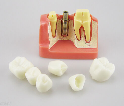 Class III Instrument Classification Dental Study Model for Dental Practice and Demonstration