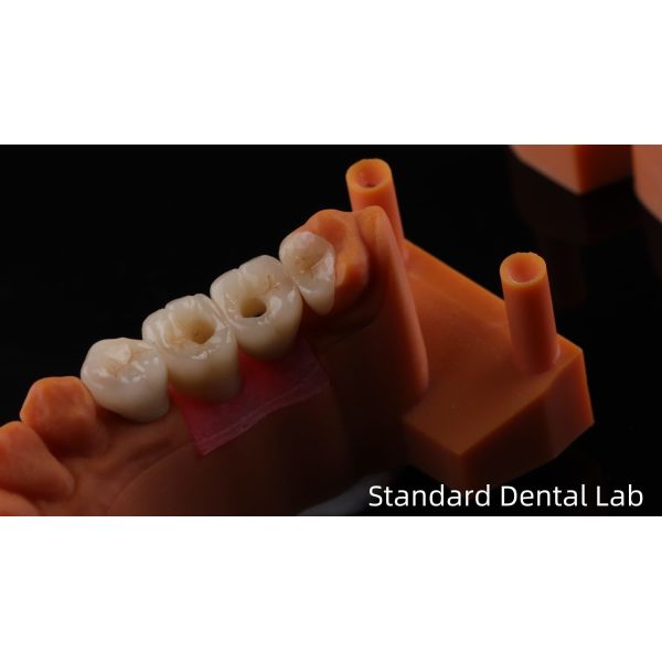 Screw Retained Dental Implant Crown with PFZ Porcelain Layered Zirconia 5-Year Gurantee and 3D Print Model