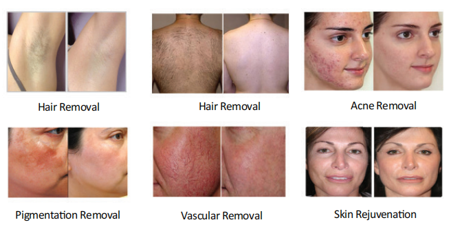 3 Hand Pieces IPL / Intense Pulsed Light Beauty Machine with Close Water Circulation