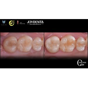 Long Lasting Natural Looking dental ceramic inlay Precise Fit High Compatibility