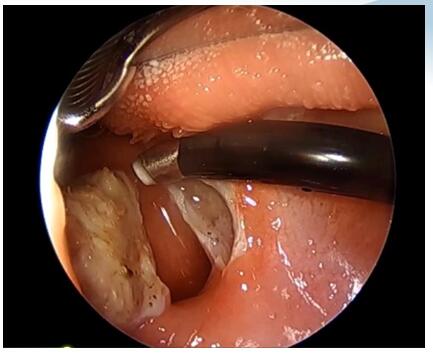 Adenoidectomy Coblator Turbinate Wand , RF ENT Plasma Surgery Electrode