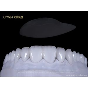 China E.max layered veneers on sale
