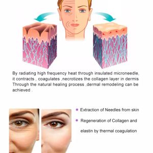 Multifunctional Microaguja RF Beauty Machine Gomecy Accessories Micro Wrinkle