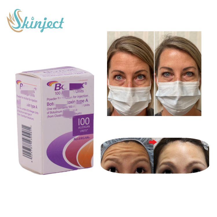 Botox treatment areas diagram