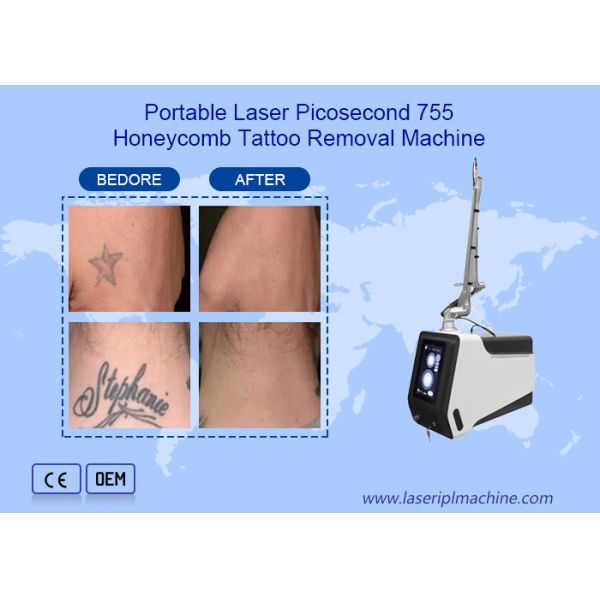 Picosecond Nd Yag Laser Machine For Freckles Removal Eyebrow Removal