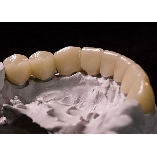 Buy Porcelain Fused to Metal Crowns - Advanced Technology for Long Lasting Smile Restoration at wholesale prices