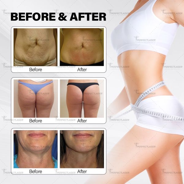 Multifunction Body Slimming Tone Fat Removal Cellulite Remove Big Roller Vacuum Cavitation Beauty Equipment With CE FDA