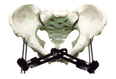 Pelvic Fracture Orthopedic External Fixator Implant Materials For Trauma