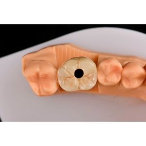 10mm Titanium Tooth Implant Sandblasted Self Tapping Dental Implants