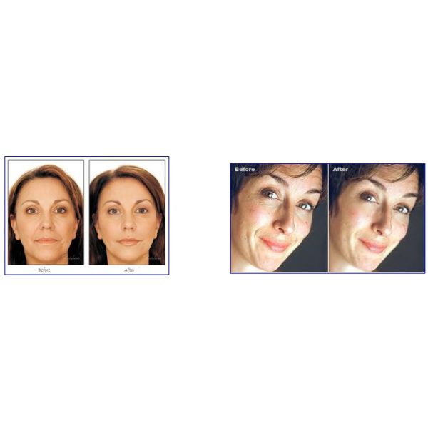 Multi - Function Beauty Salon E-light IPL RF Hair Removal Skin Rejuvenation Machine