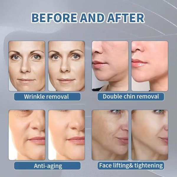 200μs Pulse Magenetic Face Sculpt Machine 0-3T Electromagnetic Wave