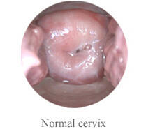 Self - Inspection Tool for Cervical Examination Digital Electronic Colposcope
