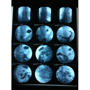 China Translucent Inkjet X Ray Film Glossy Surface Silk Screen Printing on sale