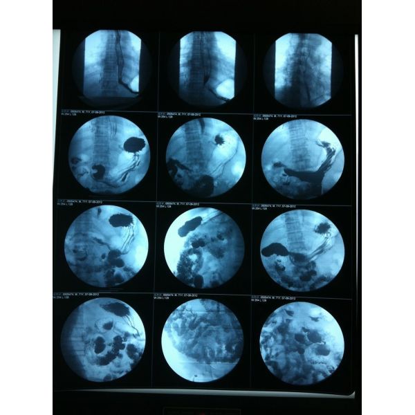 Buy Translucent Inkjet X Ray Film Glossy Surface Silk Screen Printing at wholesale prices