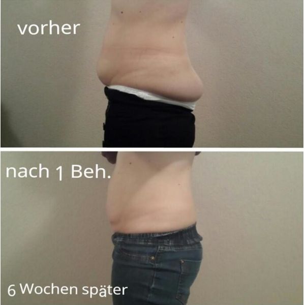 Beautiful Design High Quality Manufacturer Direct Sale Portable Cryolipolysis Machine For