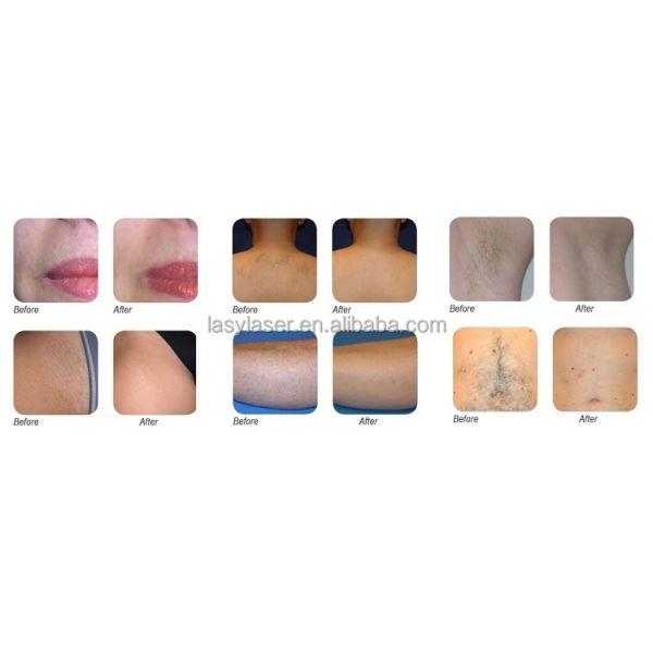 808nm Diode LED Skin Rejuvenation Machine 220v Yag Laser Hair Removal