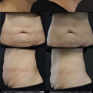 Diode Laser Vascular Removal Machine Endolift Varicose Vein Machine