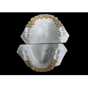 Comfortable Porcelain Dental Bridge with All-Ceramic Construction for Exceptiona