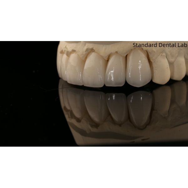 Full Contour Zirconia Crown and High Aesthetic Natural Dental Bridge 5 Year Guarantee