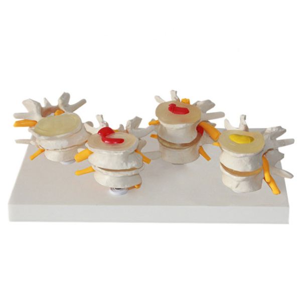 Buy Vertebrae Diseased 4 Stage PVC Human Lumbar Spine Anatomy Model at wholesale prices