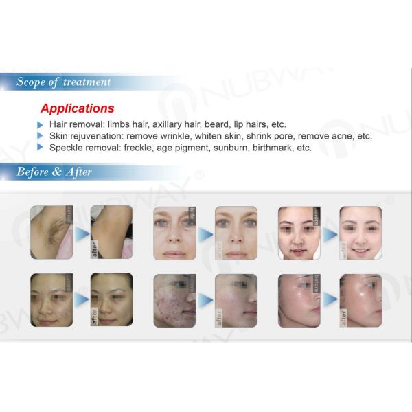 best professional ipl machine for hair removal fda approved ipl laser machine