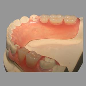 Casting Pink TCS Flexible Partials with Excellent Retention