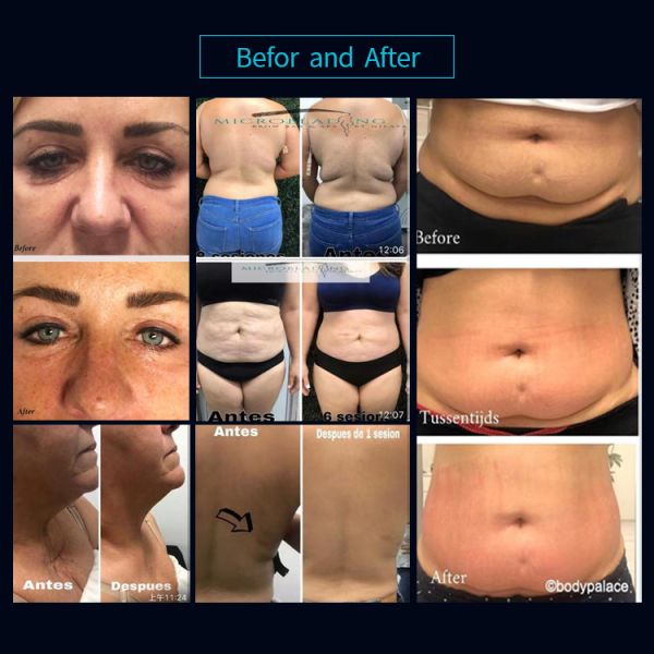 LCD Vela Shape Vacuum Slimming Machine Body And Face Treatment