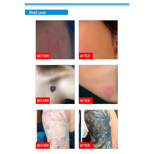 IPL OPT Beauty Machine