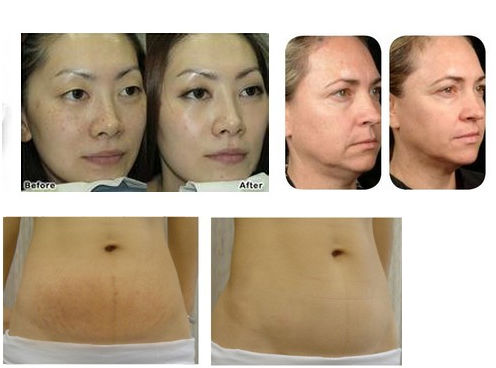 2014Hight quality!! Professional Hifu machine rf skin tightening machine