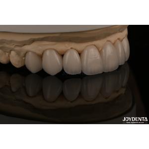 Feldspathic Natural Looking Cosmetic Veneers Precise Fit Highly Translucent