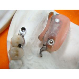 Dental Lab Long Lasting Precision Attachment Denture Stain Resistant