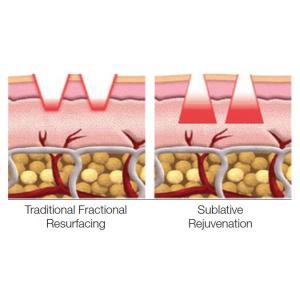 Sublative RF Machine Innovative Skin Resurfacing And Facial Countour Technology