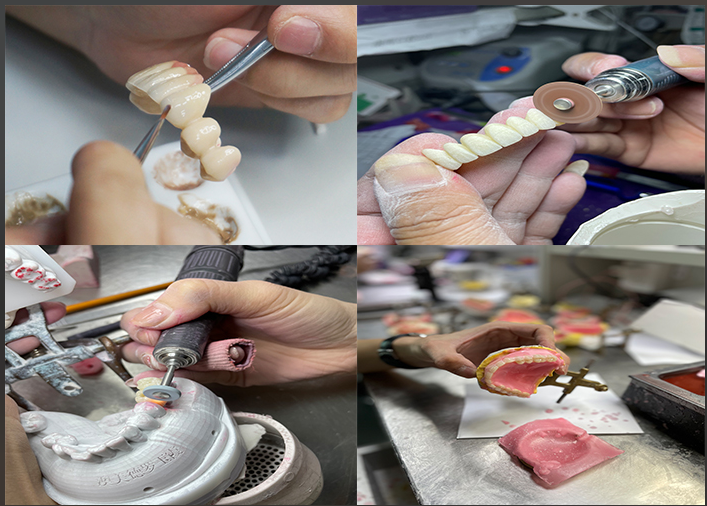 IPS e.max Veneers for incisor in shade A1 Natural Aesthetics for Flawless Smiles