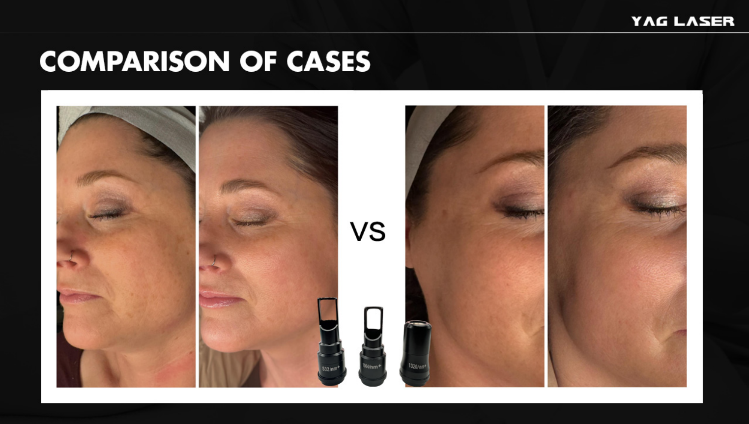 12.1 Inch Touch Screen High Power Q Switch Nd Yag Picosecond Laser For Tattoo Removal